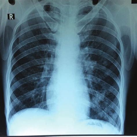 Chest radiographs (a) apicolordotic view revealed fibrotic .